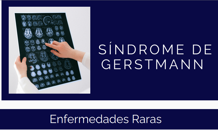 Imagen representativa de Hablando de enfermedades raras: síndrome de Gerstmann