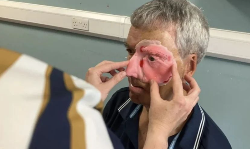 Imagen representativa de la impresión 3D le ofrece una prótesis facial.