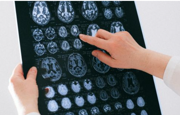 Imagen representativa de la salud cerebral